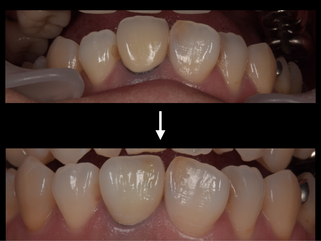 セラミック技工について - BACONDENTALFACTORY